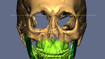 3D Virtual Surgery program